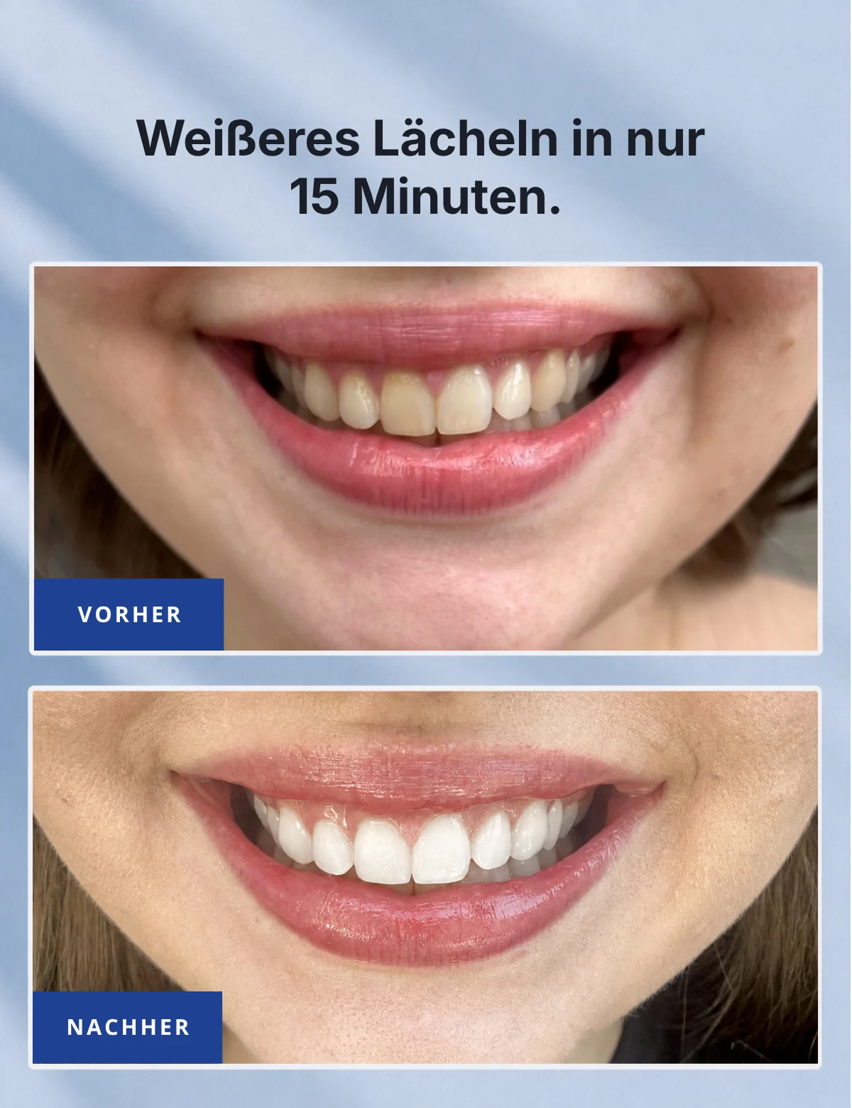 Weißeres Lächeln in nur 15 Minuten – Vorher-Nachher-Vergleich