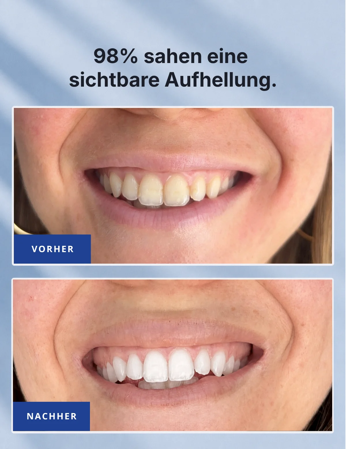 98 % sahen eine sichtbare Aufhellung – Vorher-Nachher-Vergleich