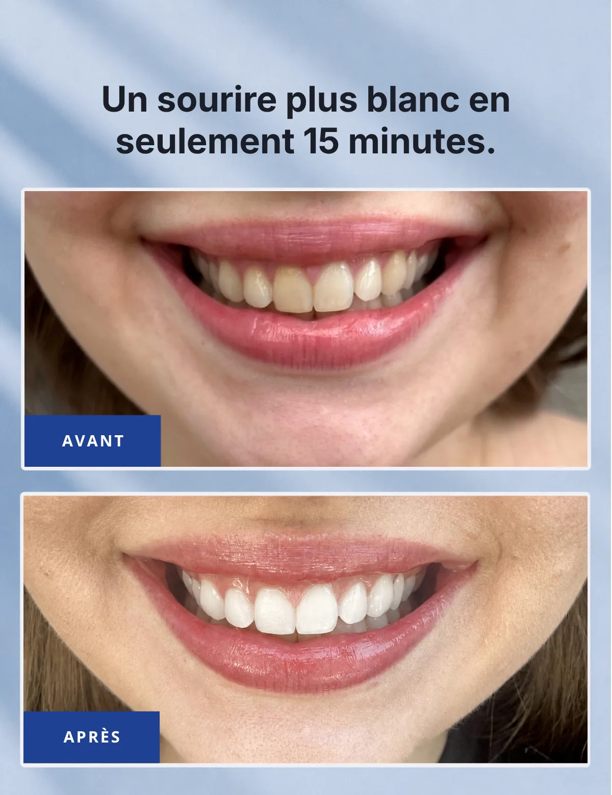 Un sourire plus blanc en seulement 15 minutes – comparaison avant/après