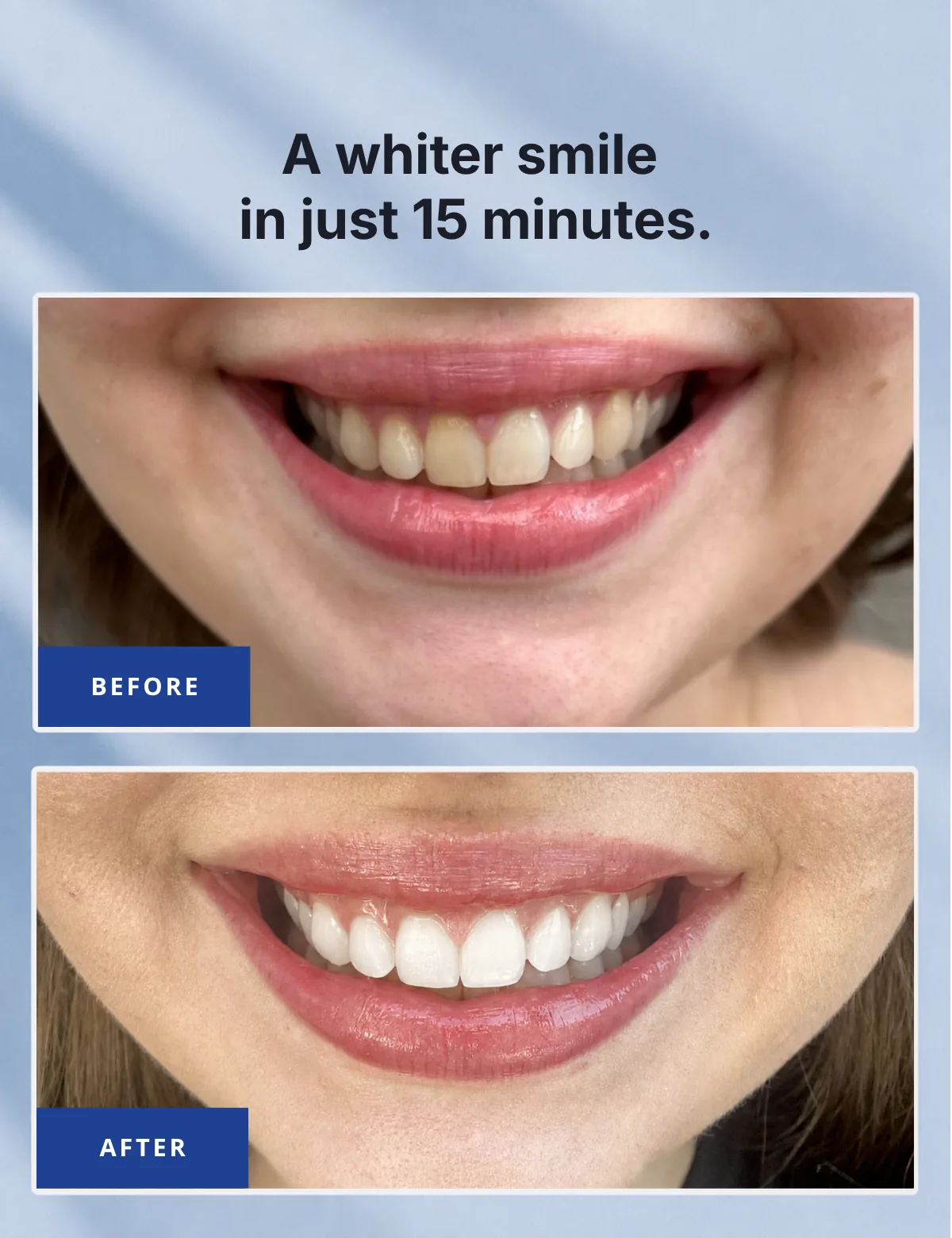 A whiter smile in just 15 minutes – before and after comparison