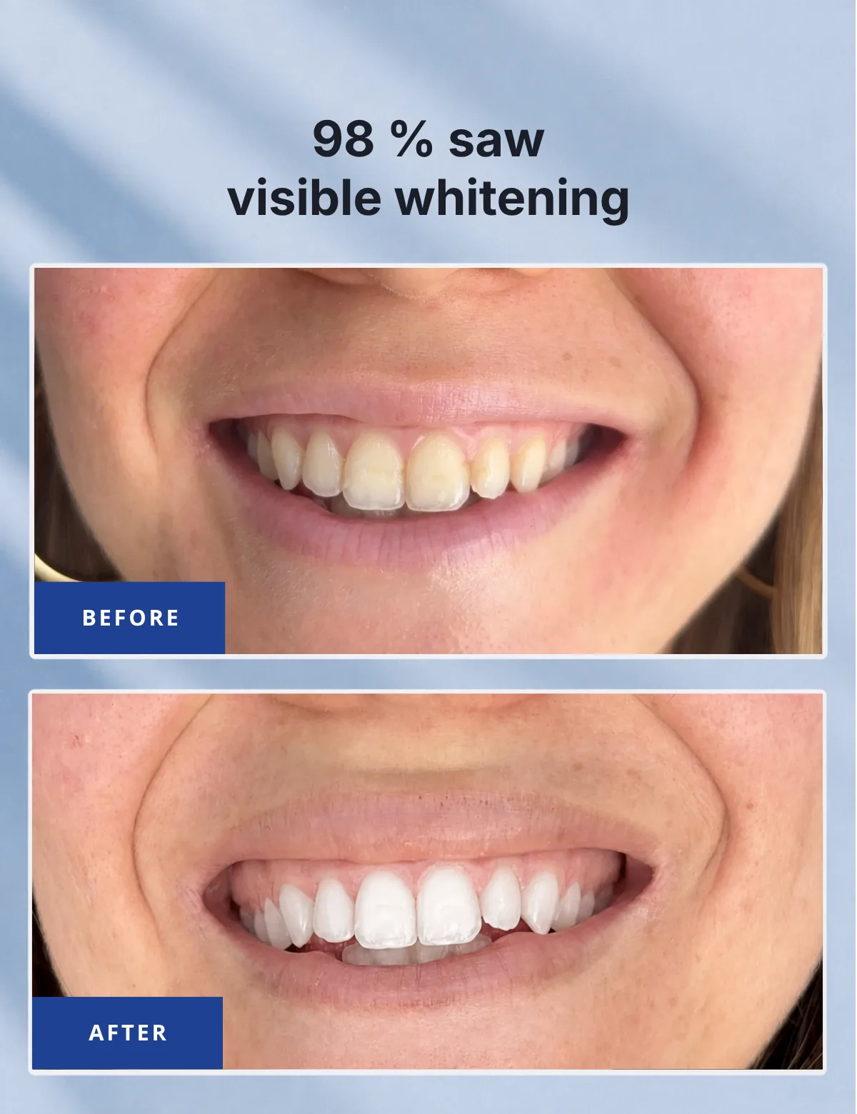 98% saw visible whitening – before and after comparison