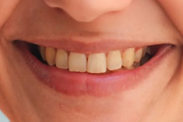 Before - Elena